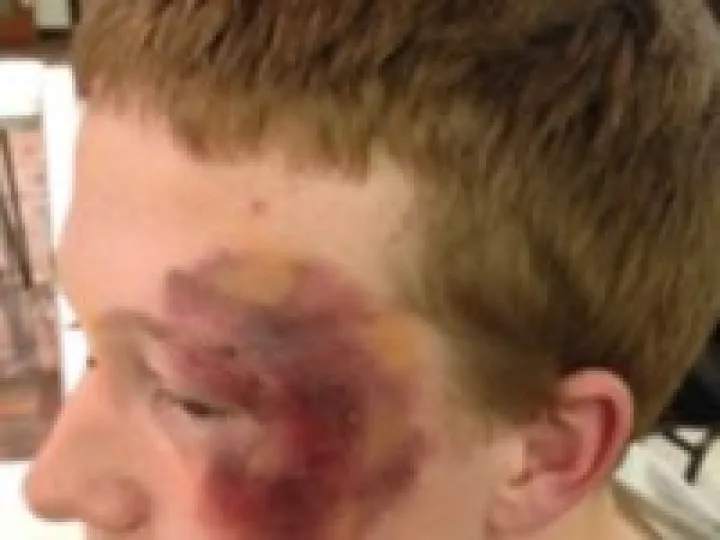 Bruised Actor
