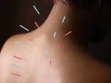 acupuncture