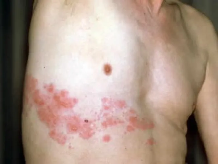 Shingles 03